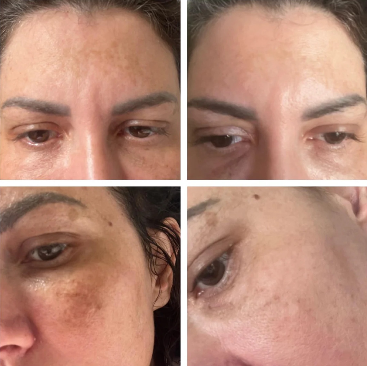 ghkcu peptide before and after injections 3-weeks